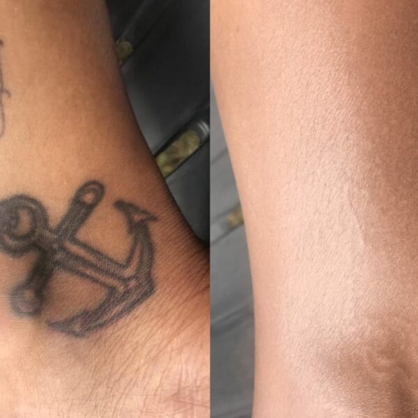 Tattoo cover up